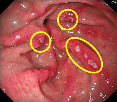 黒色便｜薬剤性胃粘膜障害｜巣鴨駅前胃腸内科クリニック